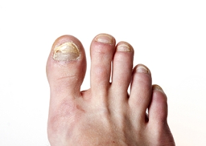 The Best Ways to Avoid Toenail Fungus