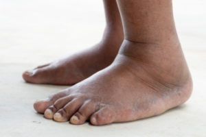 Foot Swelling Caused by Psoriatic Arthritis