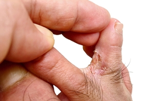 Common Symptoms of Athlete’s Foot