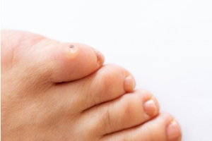 Causes of Corns on the Feet