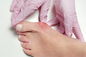 Surgical Options for Bunions