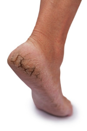 How to Treat and Prevent Cracked Heels at Home