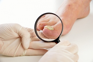 Signs I May Have Toenail Fungus